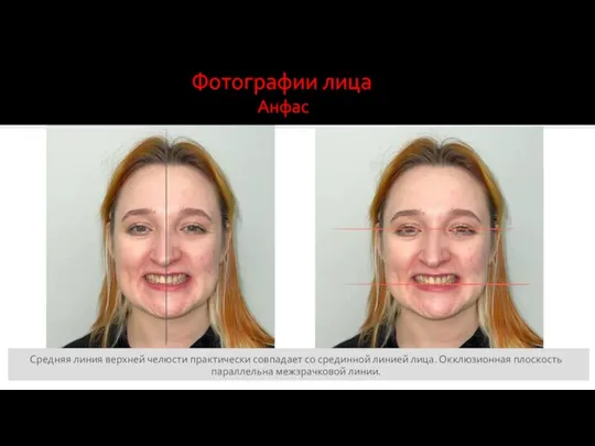 Фотографии лица Анфас Средняя линия верхней челюсти практически совпадает со