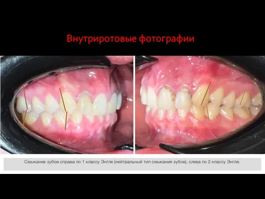 Смыкание зубов справа по 1 классу Энгля (нейтральный тип смыкания