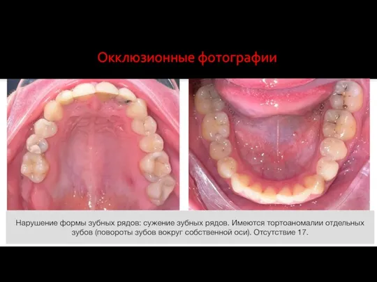 Нарушение формы зубных рядов: сужение зубных рядов. Имеются тортоаномалии отдельных