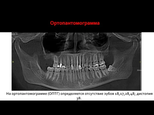 На ортопантомограмме (ОПТГ) определяется отсутствие зубов 18,17,28,48; дистопия 38. Ортопантомограмма