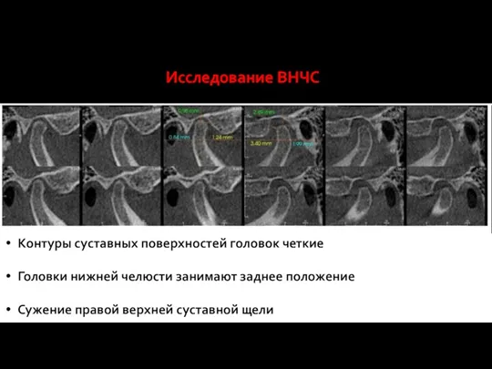 Исследование ВНЧС Контуры суставных поверхностей головок четкие Головки нижней челюсти