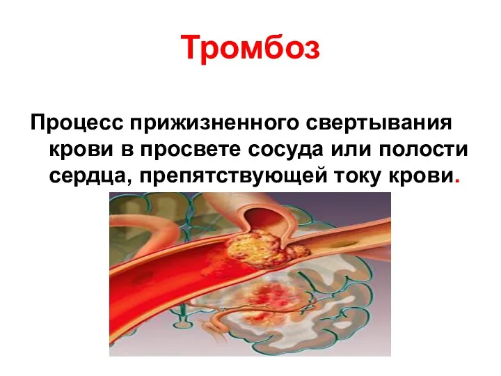 Тромбоз Процесс прижизненного свертывания крови в просвете сосуда или полости сердца, препятствующей току крови.