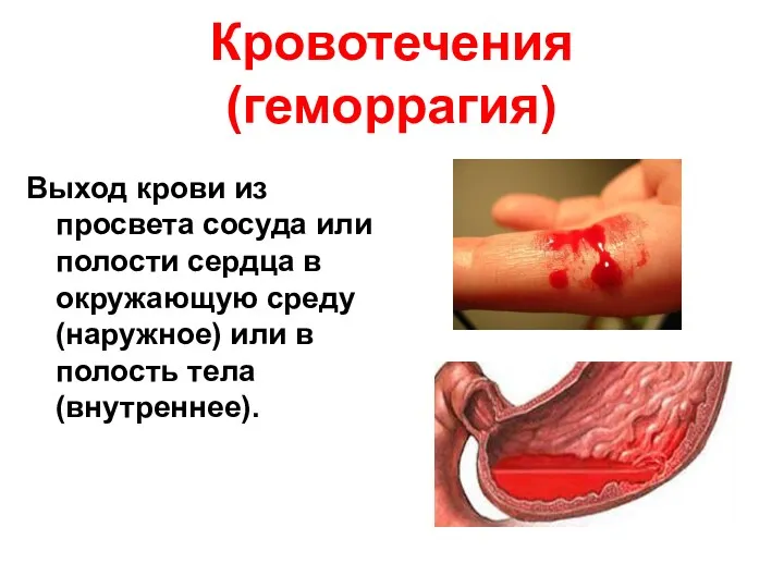 Кровотечения(геморрагия) Выход крови из просвета сосуда или полости сердца в окружающую среду (наружное)