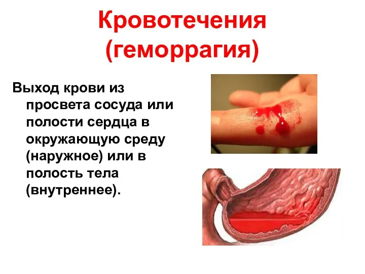 Кровотечения(геморрагия) Выход крови из просвета сосуда или полости сердца в