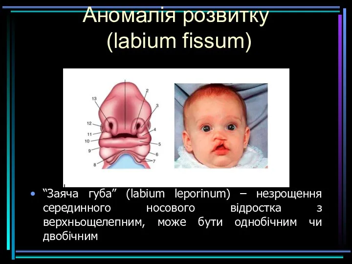 Аномалія розвитку (labium fissum) “Заяча губа” (labium leporinum) – незрощення