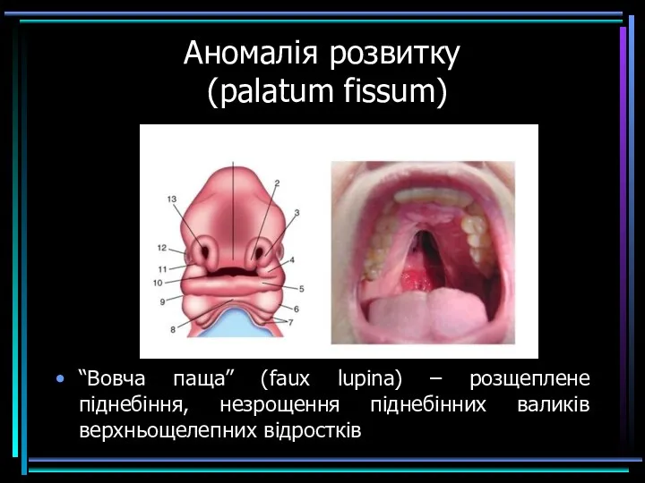 Аномалія розвитку (palatum fissum) “Вовча паща” (faux lupina) – розщеплене піднебіння, незрощення піднебінних валиків верхньощелепних відростків