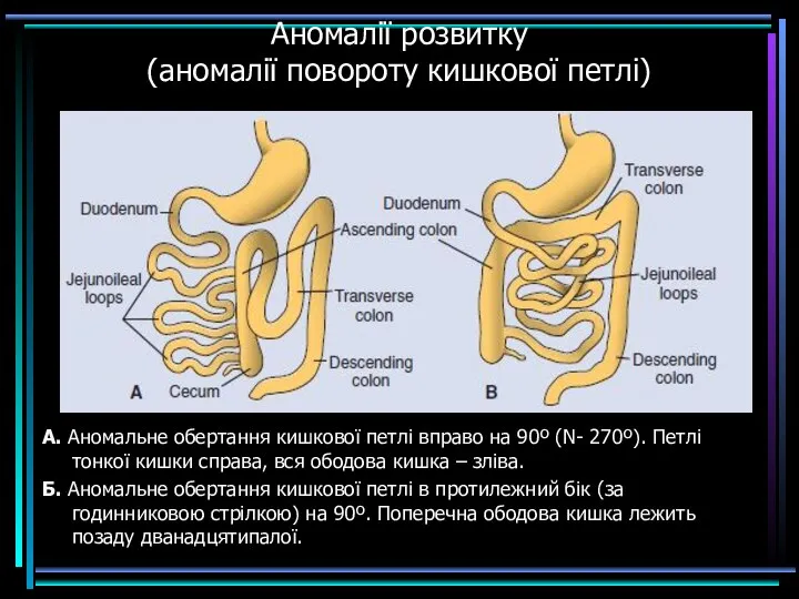 Аномалії розвитку (аномалії повороту кишкової петлі) А. Аномальне обертання кишкової