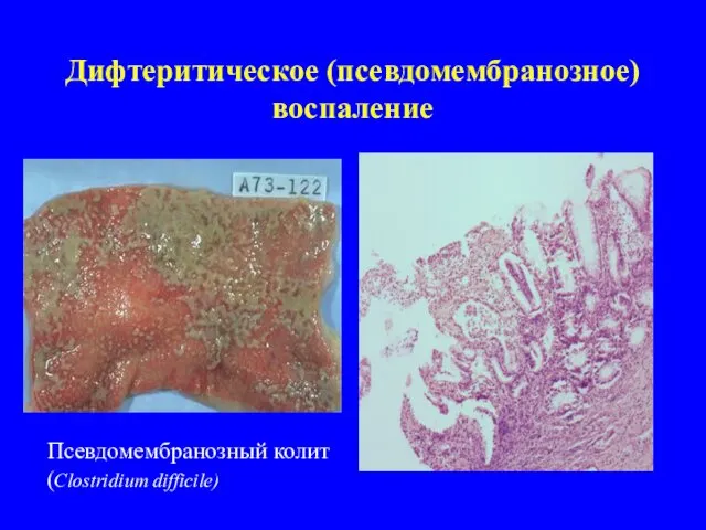 Дифтеритическое (псевдомембранозное) воспаление Псевдомембранозный колит (Clostridium difficile)