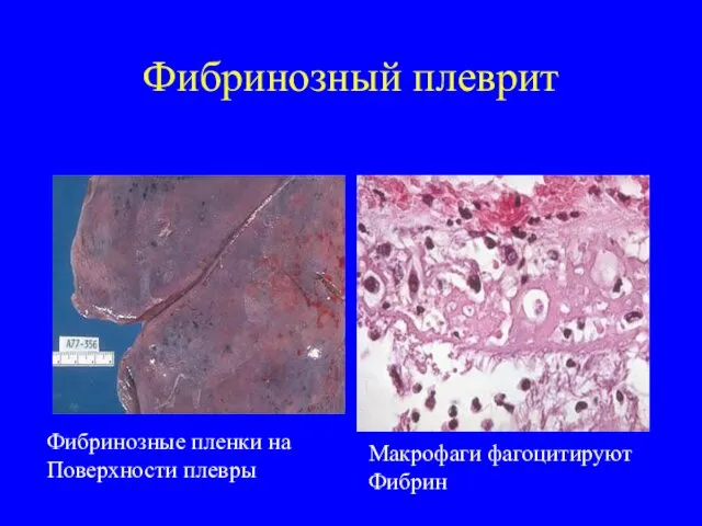 Фибринозный плеврит Фибринозные пленки на Поверхности плевры Макрофаги фагоцитируют Фибрин