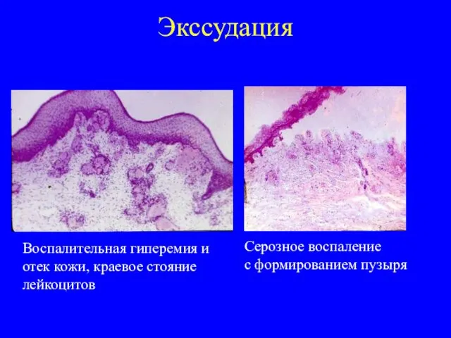 Экссудация Воспалительная гиперемия и отек кожи, краевое стояние лейкоцитов Серозное воспаление с формированием пузыря