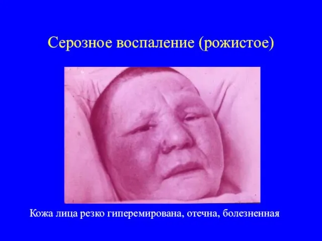 Серозное воспаление (рожистое) Кожа лица резко гиперемирована, отечна, болезненная