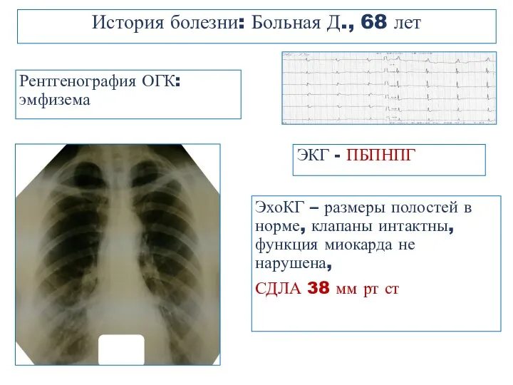 История болезни: Больная Д., 68 лет ЭКГ - ПБПНПГ ЭхоКГ