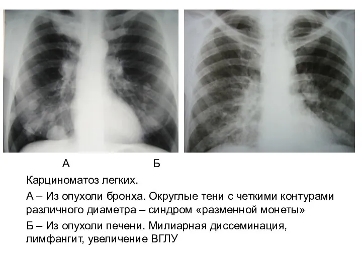 А Б Карциноматоз легких. А – Из опухоли бронха. Округлые