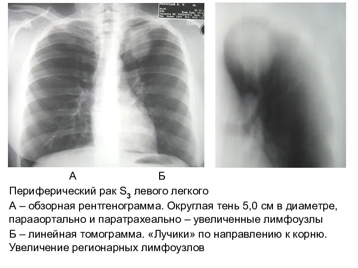 А Б Периферический рак S3 левого легкого А – обзорная