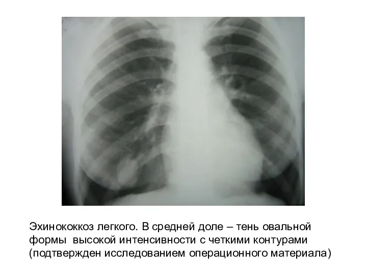 Эхинококкоз легкого. В средней доле – тень овальной формы высокой интенсивности с четкими