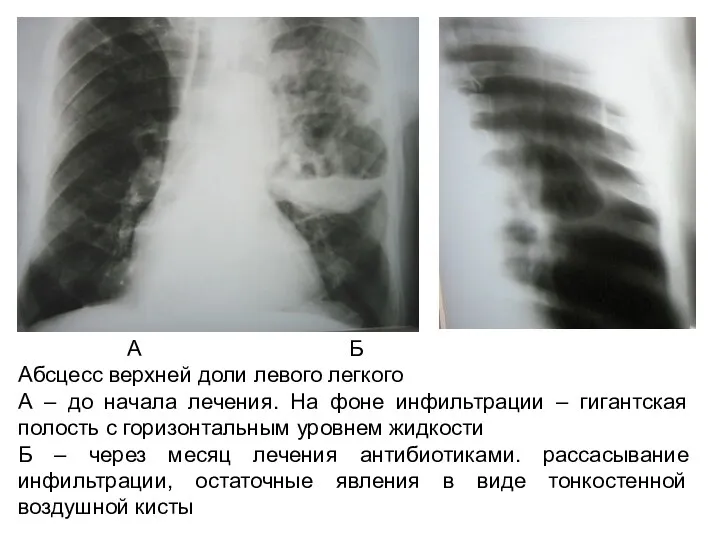 А Б Абсцесс верхней доли левого легкого А – до начала лечения. На