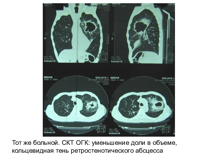 Тот же больной. СКТ ОГК: уменьшение доли в объеме, кольцевидная тень ретростенотического абсцесса