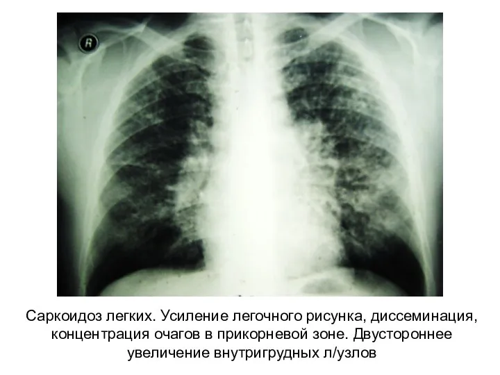 Саркоидоз легких. Усиление легочного рисунка, диссеминация, концентрация очагов в прикорневой зоне. Двустороннее увеличение внутригрудных л/узлов