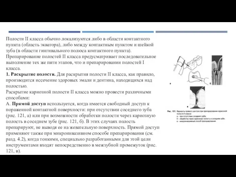 Полости II класса обычно локализуются либо в области контактного пункта