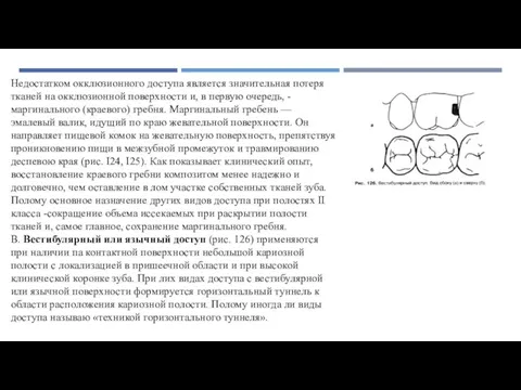 Недостатком окклюзионного доступа является значительная потеря тканей на окклюзионной поверхности