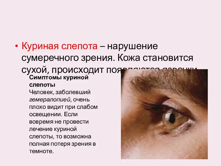 Куриная слепота – нарушение сумеречного зрения. Кожа становится сухой, происходит