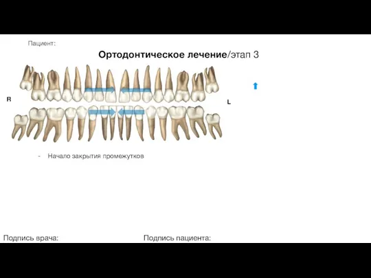 Пациент: Ортодонтическое лечение/этап 3 Подпись врача: Подпись пациента: R L - Начало закрытия промежутков