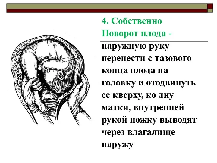 4. Собственно Поворот плода - наружную руку перенести с тазового