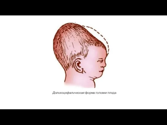 Долихоцефалическая форма головки плода