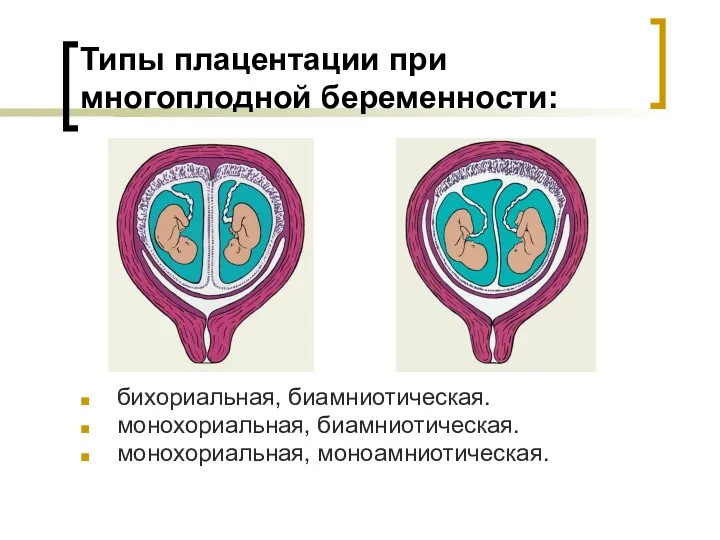 Типы плацентации при многоплодной беременности: бихориальная, биамниотическая. монохориальная, биамниотическая. монохориальная, моноамниотическая.