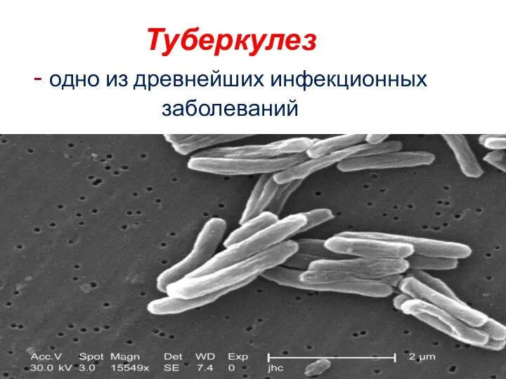 Туберкулез - одно из древнейших инфекционных заболеваний