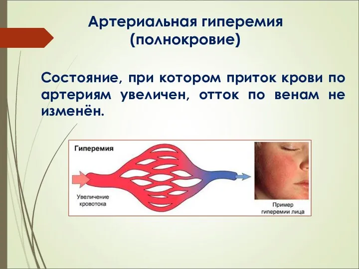 Артериальная гиперемия (полнокровие) Состояние, при котором приток крови по артериям увеличен, отток по венам не изменён.