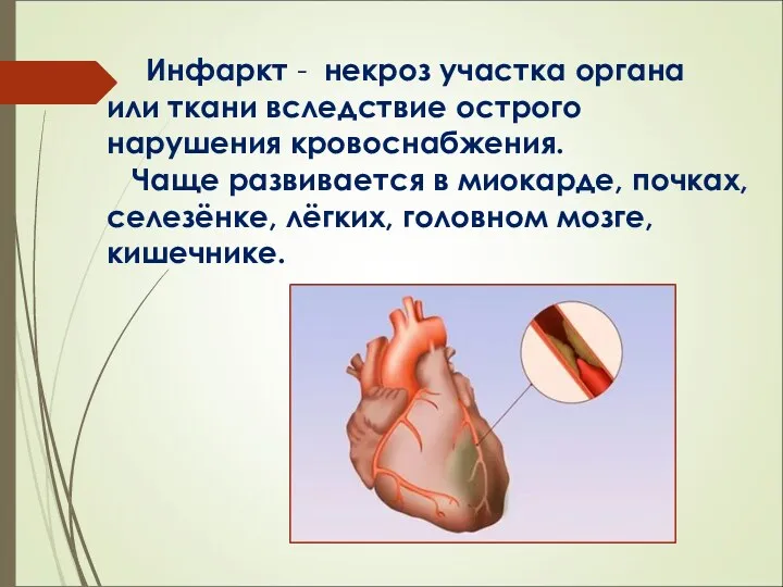 Инфаркт - некроз участка органа или ткани вследствие острого нарушения