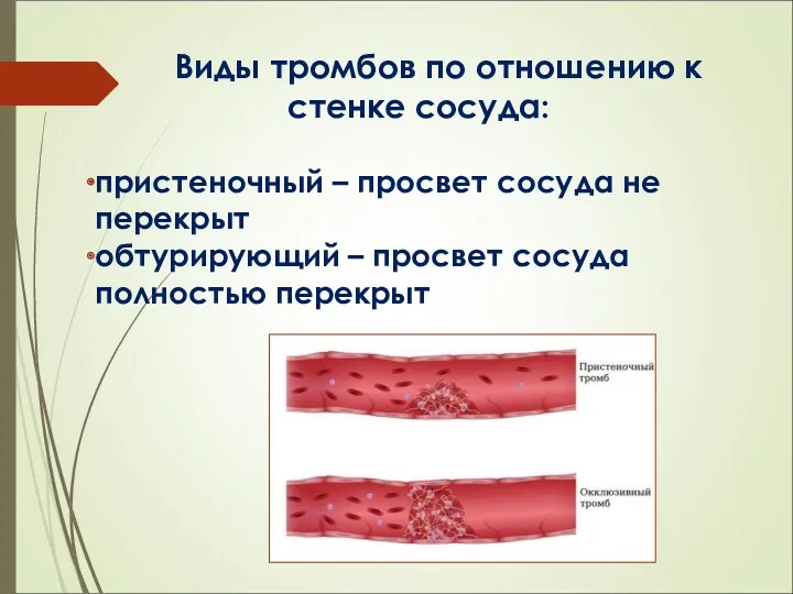 Виды тромбов по отношению к стенке сосуда: пристеночный – просвет