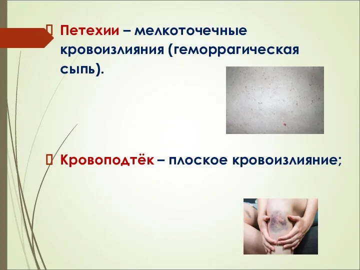 Петехии – мелкоточечные кровоизлияния (геморрагическая сыпь). Кровоподтёк – плоское кровоизлияние;