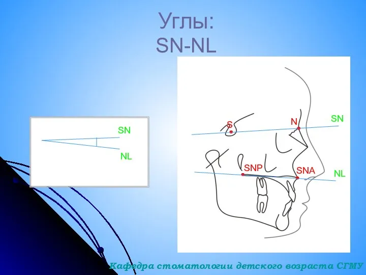 Углы: SN-NL S N SN SNP SNA NL SN NL Кафедра стоматологии детского возраста СГМУ