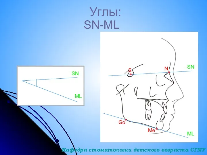 Углы: SN-ML S N SN Go Me ML SN ML Кафедра стоматологии детского возраста СГМУ