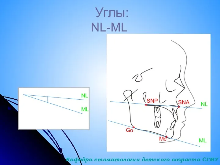 Углы: NL-ML Go Me ML SNP SNA NL ML NL Кафедра стоматологии детского возраста СГМУ