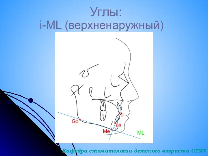 Углы: i-ML (верхненаружный) Go Me ML aii Ii Кафедра стоматологии детского возраста СГМУ