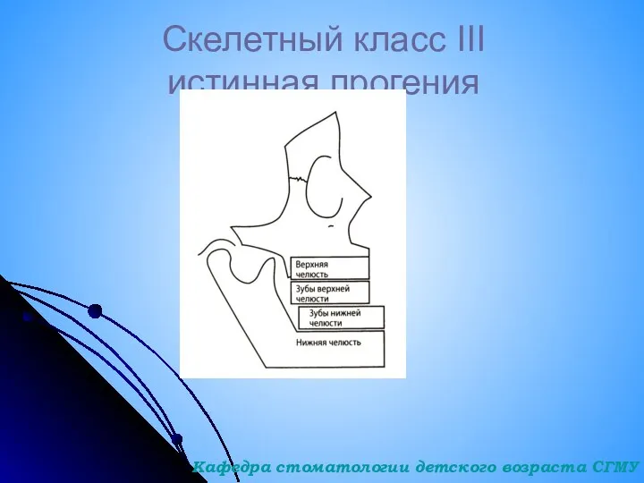 Скелетный класс III истинная прогения Кафедра стоматологии детского возраста СГМУ