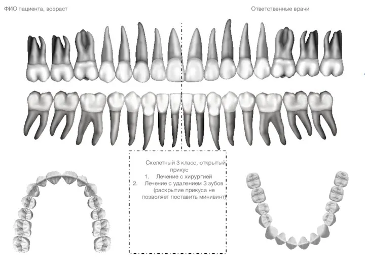 Скелетный 3 класс, открытый прикус Лечение с хирургией Лечение с удалением 3 зубов(раскрытие