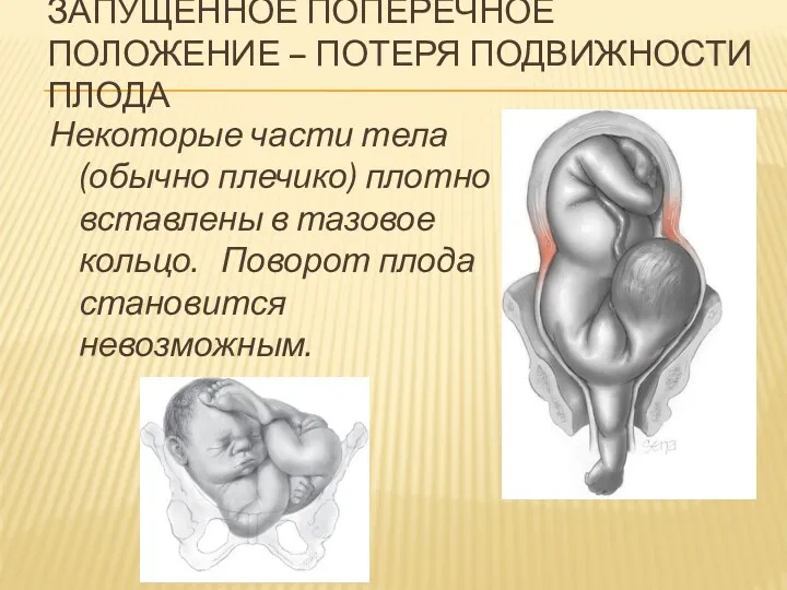 ЗАПУЩЕННОЕ ПОПЕРЕЧНОЕ ПОЛОЖЕНИЕ – ПОТЕРЯ ПОДВИЖНОСТИ ПЛОДА Некоторые части тела (обычно плечико) плотно