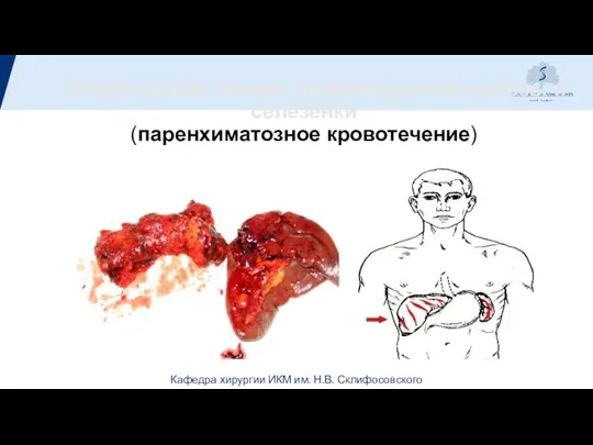 Повреждения печени, поджелудочной железы и селезенки (паренхиматозное кровотечение)