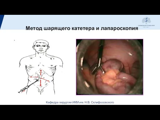 Метод шарящего катетера и лапароскопия