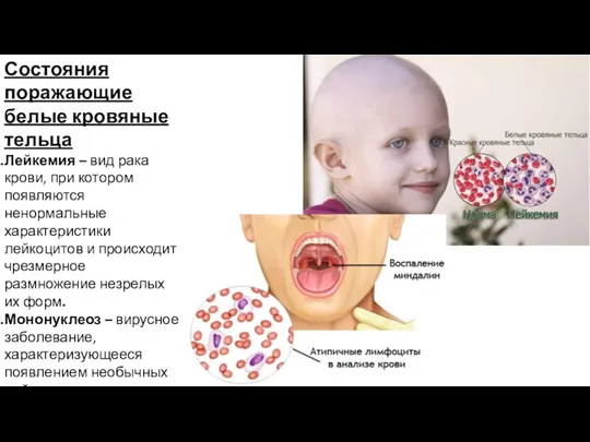 Состояния поражающие белые кровяные тельца Лейкемия – вид рака крови,