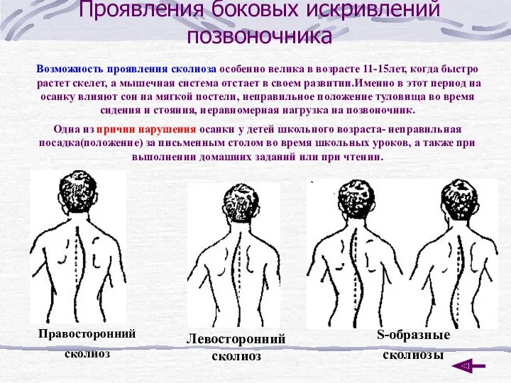 Проявления боковых искривлений позвоночника Возможность проявления сколиоза особенно велика в