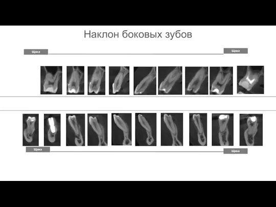 Щека Щека Щека Щека Наклон боковых зубов