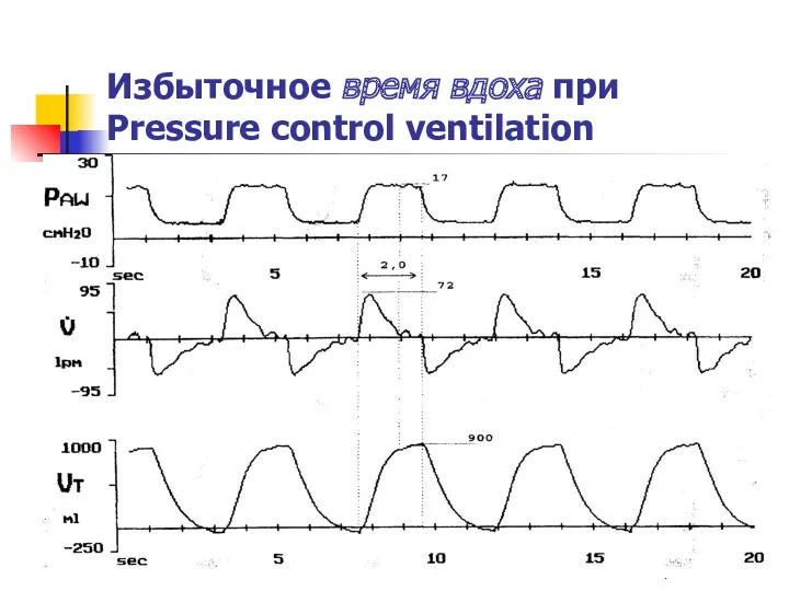 Избыточное время вдоха при Pressure control ventilation