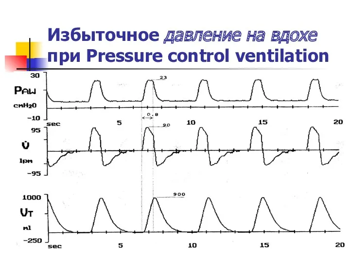 Избыточное давление на вдохе при Pressure control ventilation