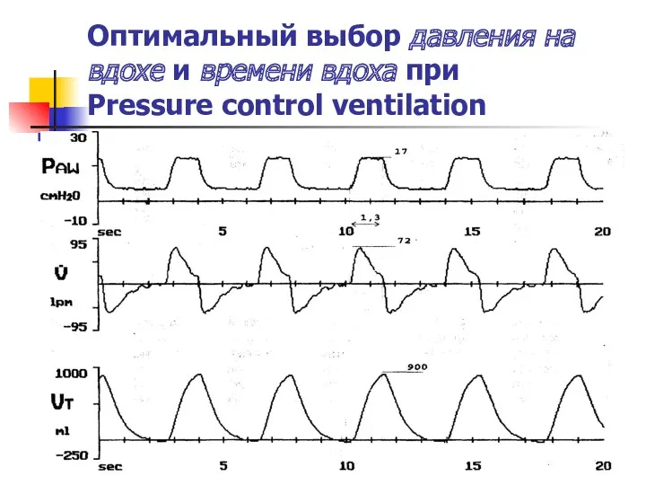 Оптимальный выбор давления на вдохе и времени вдоха при Pressure control ventilation