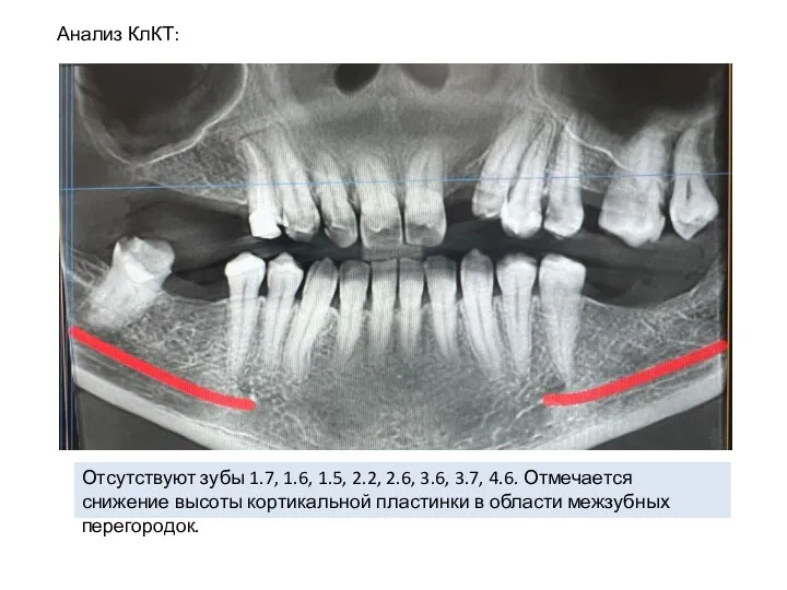 Анализ КлКТ: Отсутствуют зубы 1.7, 1.6, 1.5, 2.2, 2.6, 3.6,